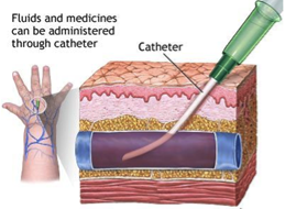 Expandable Angiocatheter